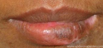Lip-Vitiligo-Graft